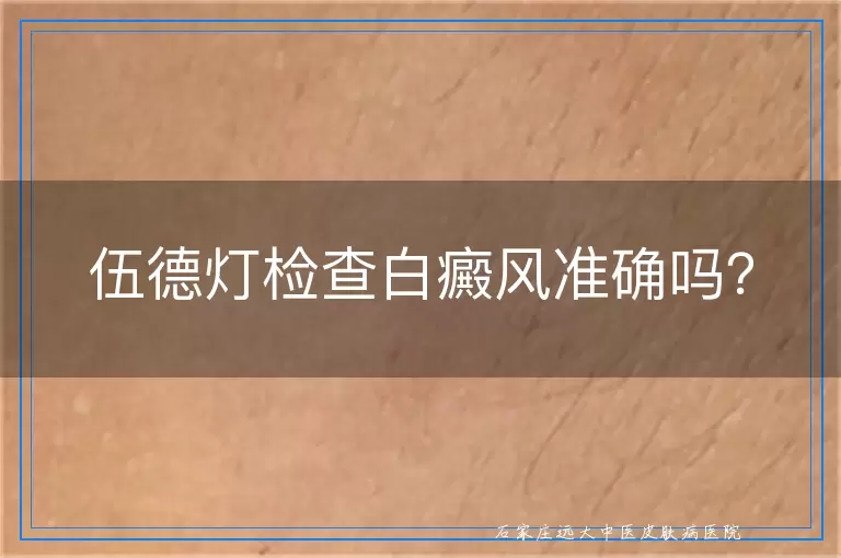 伍德灯检查白癜风准确吗？