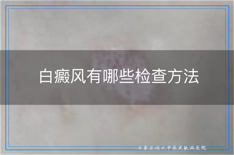 白癜风有哪些检查方法