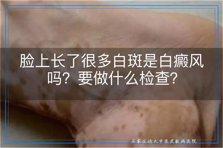 脸上长了很多白斑是白癜风吗？要做什么检查？