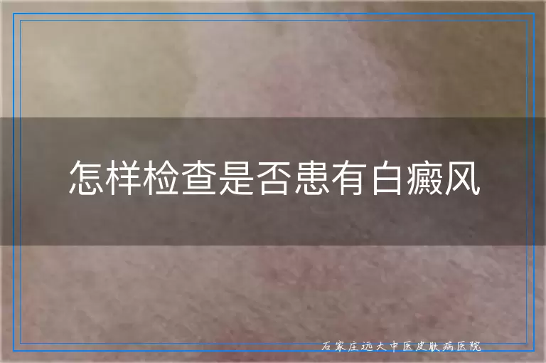 怎样检查是否患有白癜风