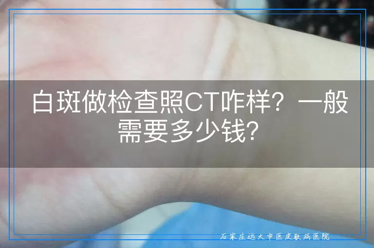 白斑做检查照CT咋样？一般需要多少钱？