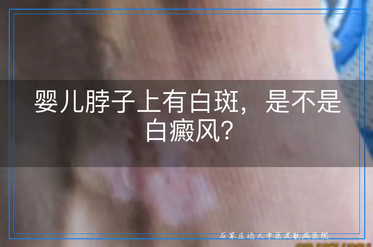 婴儿脖子上有白斑，是不是白癜风？