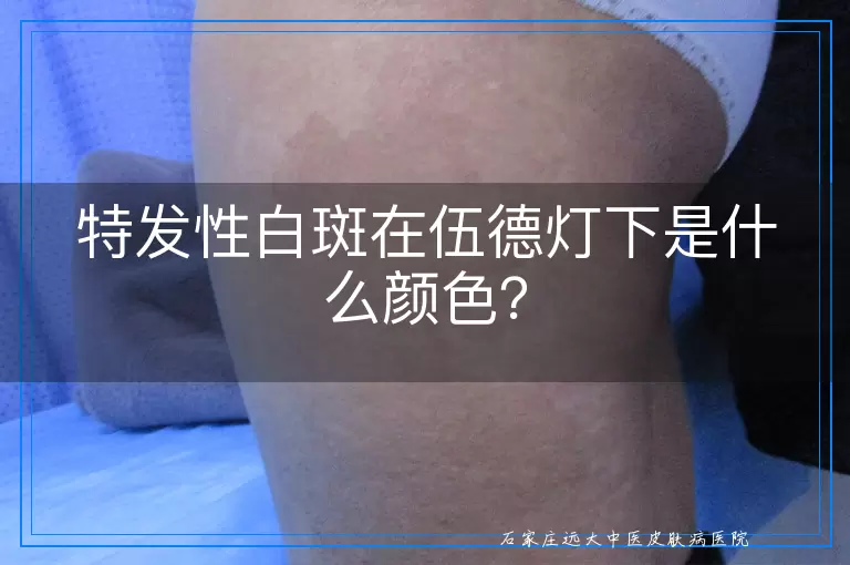 特发性白斑在伍德灯下是什么颜色？