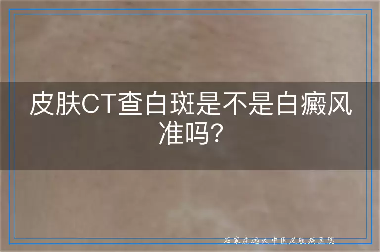 皮肤CT查白斑是不是白癜风准吗？