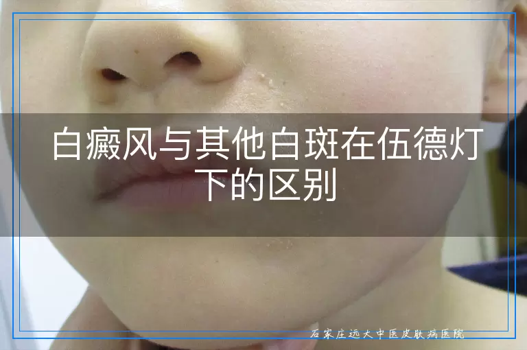 白癜风与其他白斑在伍德灯下的区别