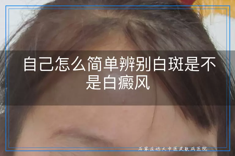 自己怎么简单辨别白斑是不是白癜风