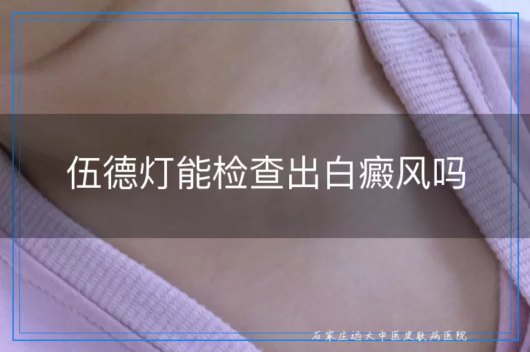 伍德灯能检查出白癜风吗