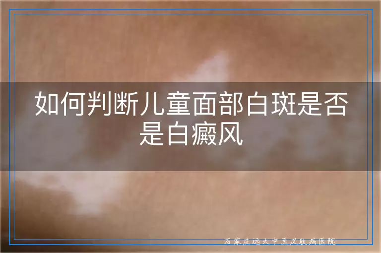 如何判断儿童面部白斑是否是白癜风