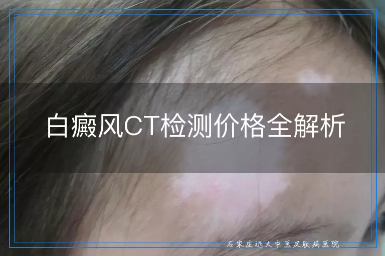 白癜风CT检测价格全解析