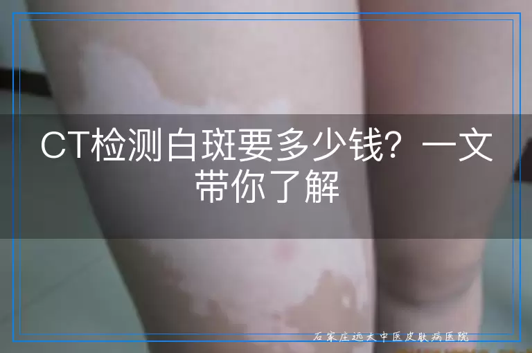 CT检测白斑要多少钱？一文带你了解