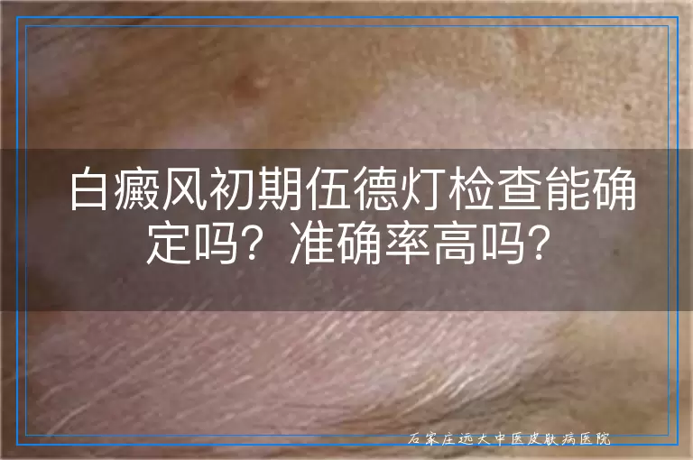 白癜风初期伍德灯检查能确定吗？准确率高吗？