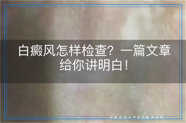 白癜风怎样检查？一篇文章给你讲明白！