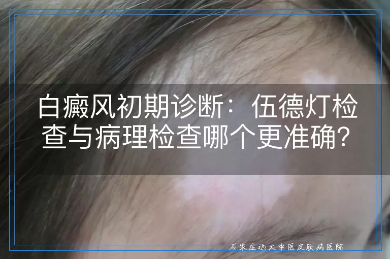 白癜风初期诊断：伍德灯检查与病理检查哪个更准确？