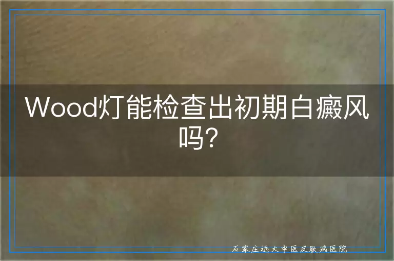 Wood灯能检查出初期白癜风吗？