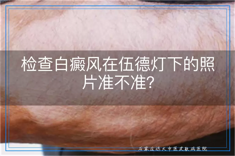 检查白癜风在伍德灯下的照片准不准？