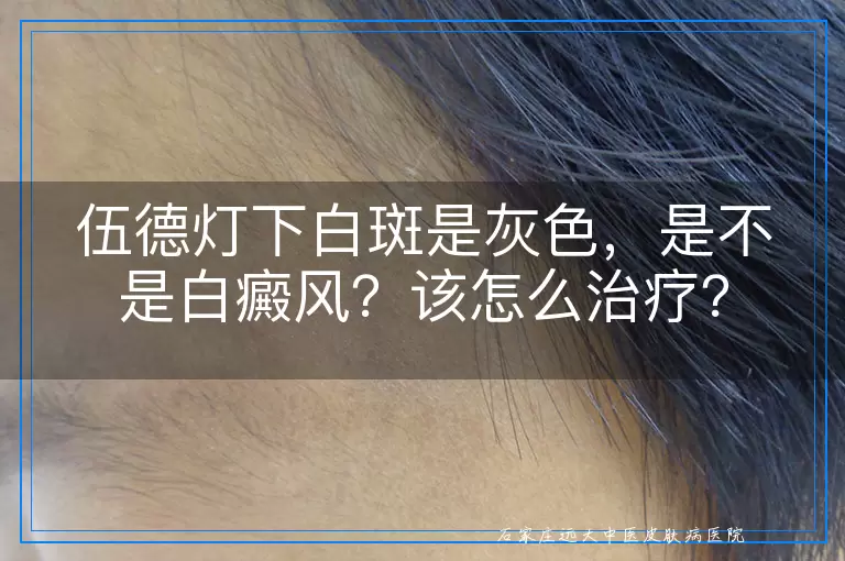 伍德灯下白斑是灰色，是不是白癜风？该怎么治疗？