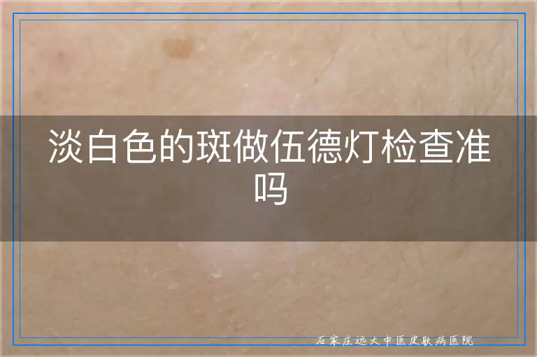 淡白色的斑做伍德灯检查准吗
