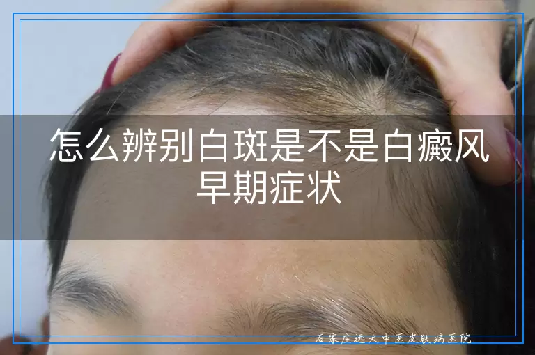 怎么辨别白斑是不是白癜风早期症状