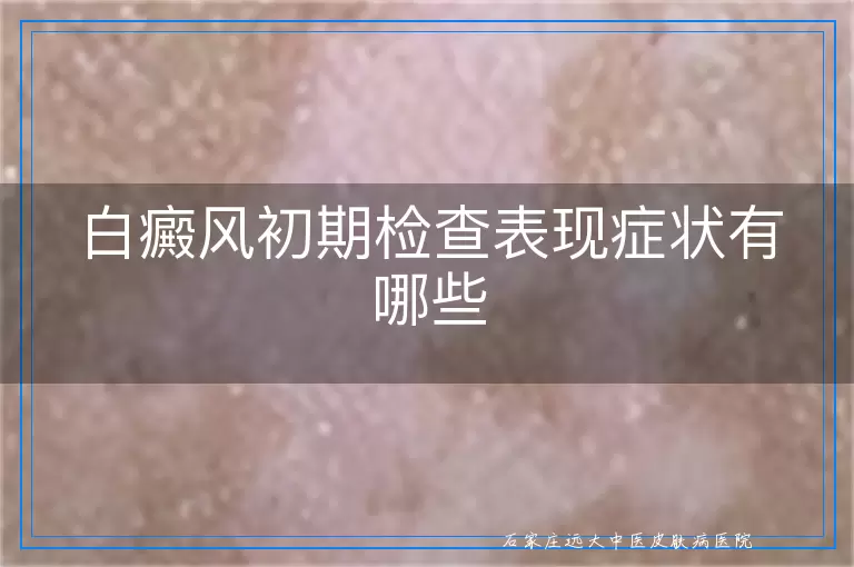 白癜风初期检查表现症状有哪些