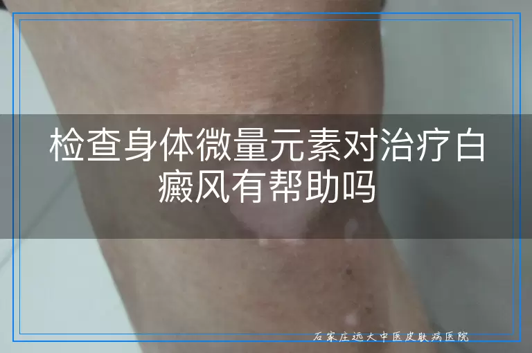 检查身体微量元素对治疗白癜风有帮助吗