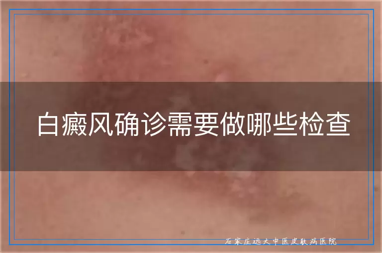 白癜风确诊需要做哪些检查