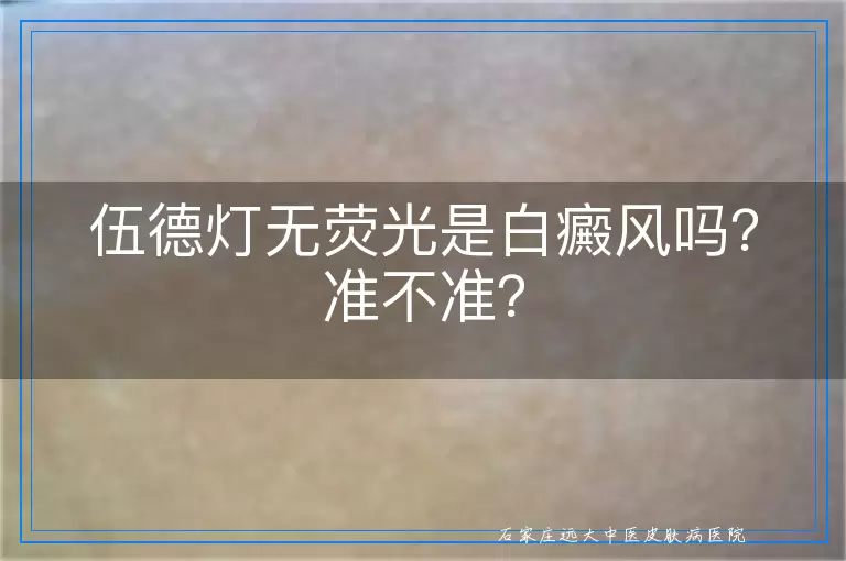 伍德灯无荧光是白癜风吗？准不准？