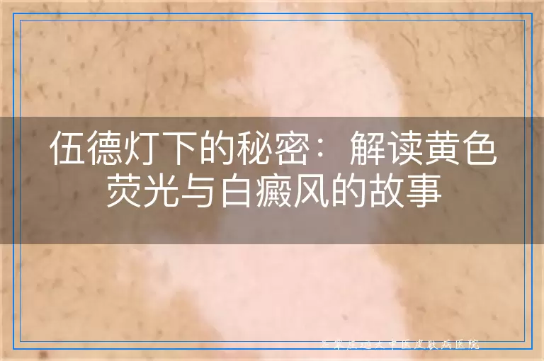 伍德灯下的秘密：解读黄色荧光与白癜风的故事