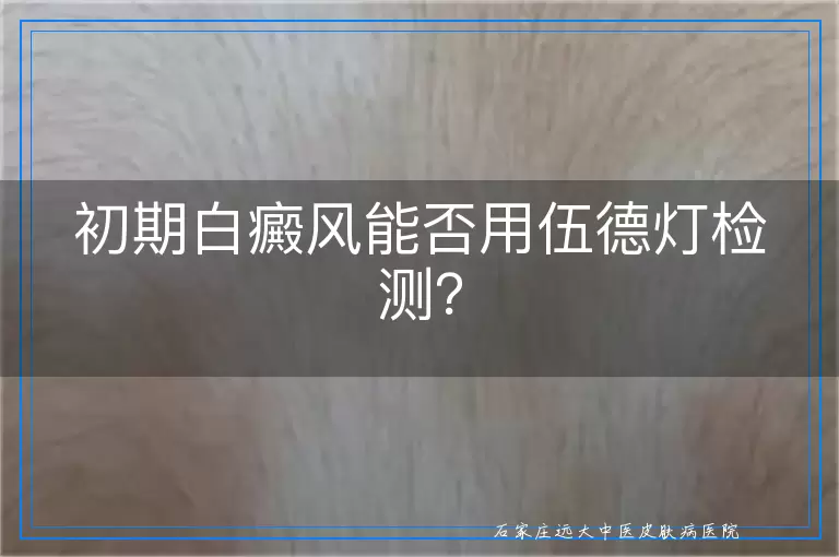 初期白癜风能否用伍德灯检测？