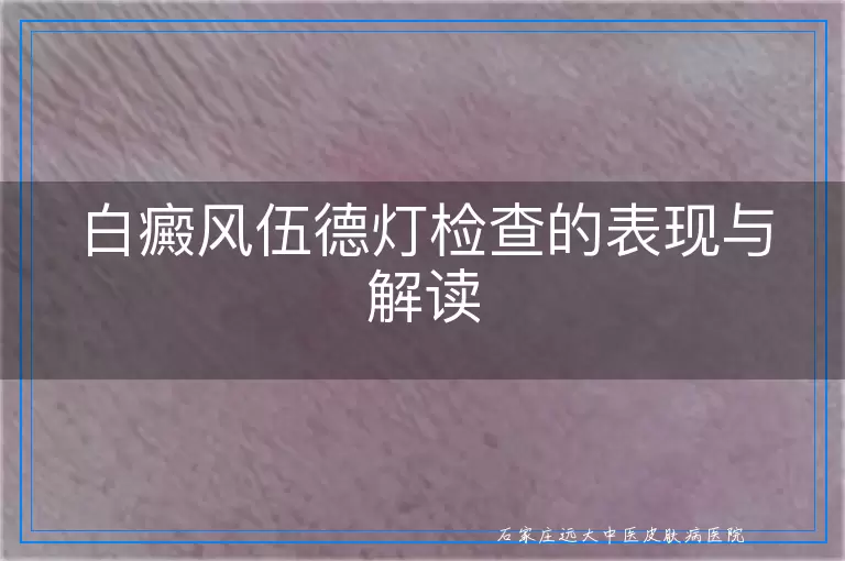 白癜风伍德灯检查的表现与解读