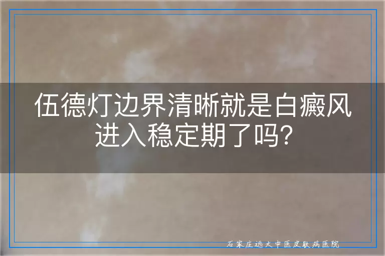 伍德灯边界清晰就是白癜风进入稳定期了吗？