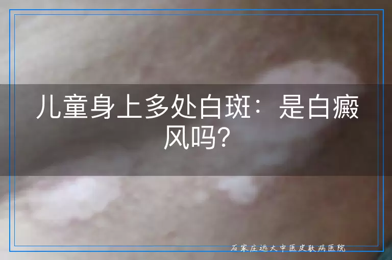 儿童身上多处白斑：是白癜风吗？