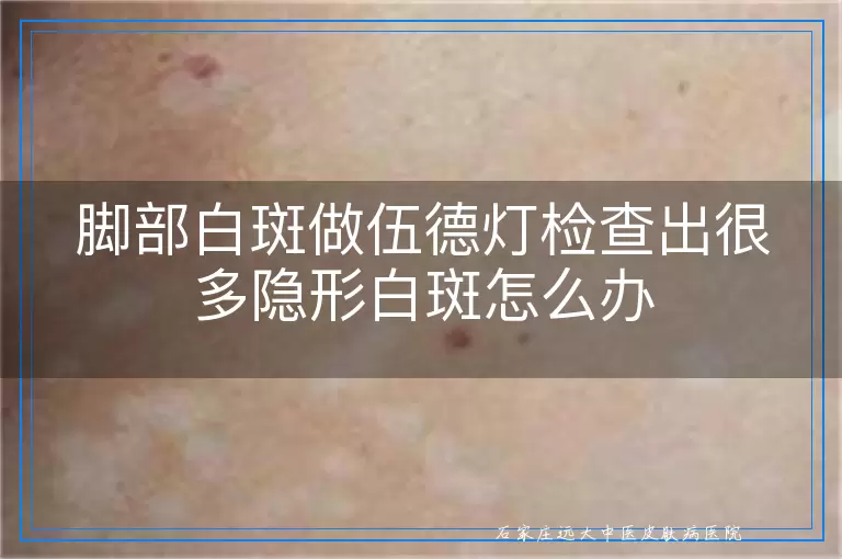 脚部白斑做伍德灯检查出很多隐形白斑怎么办