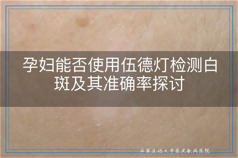 孕妇能否使用伍德灯检测白斑及其准确率探讨