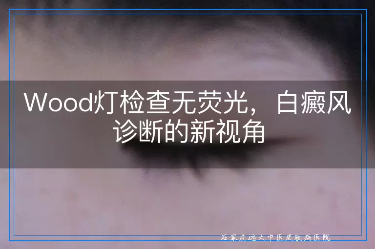 Wood灯检查无荧光，白癜风诊断的新视角