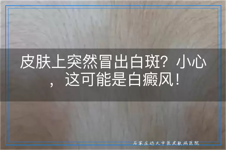 皮肤上突然冒出白斑？小心，这可能是白癜风！