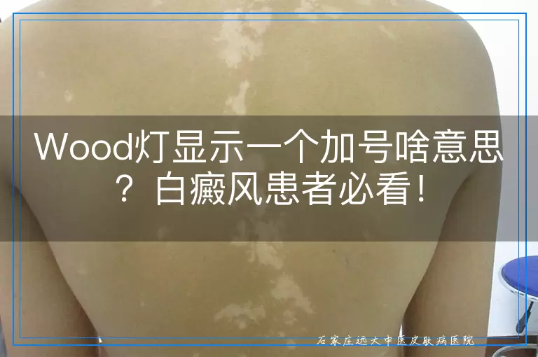 Wood灯显示一个加号啥意思？白癜风患者必看！