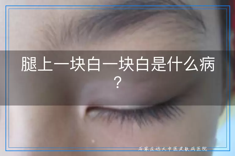 腿上一块白一块白是什么病？