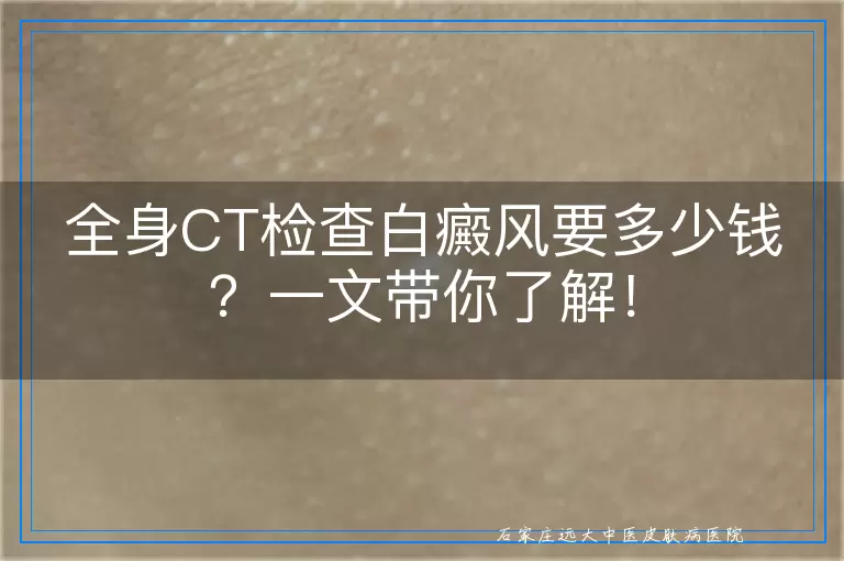 全身CT检查白癜风要多少钱？一文带你了解！