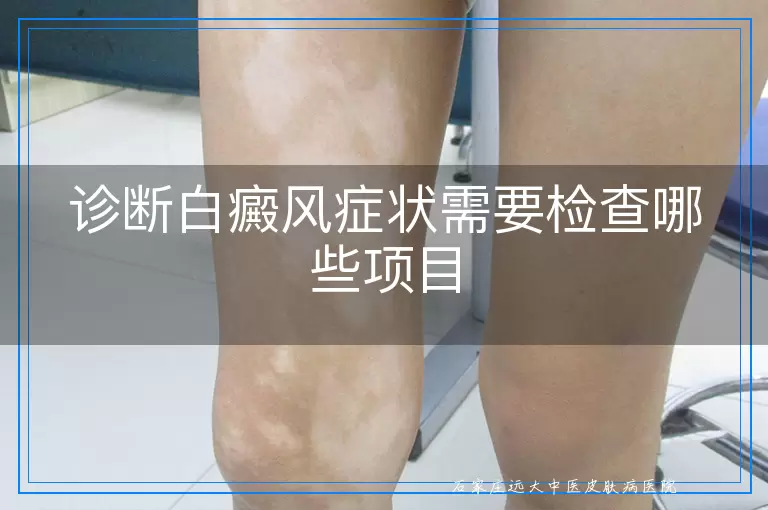 诊断白癜风症状需要检查哪些项目
