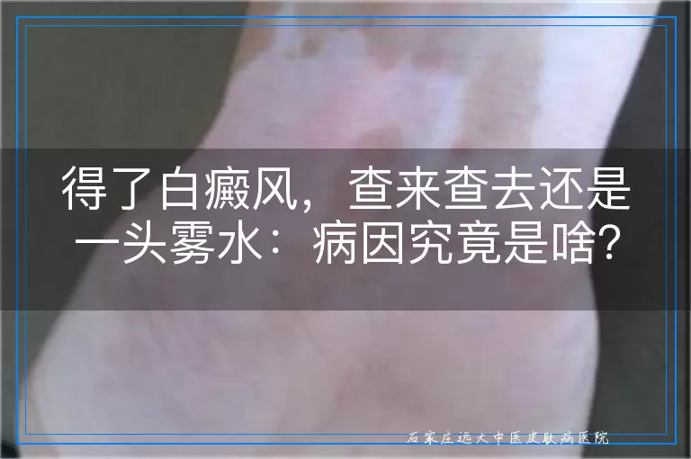 得了白癜风，查来查去还是一头雾水：病因究竟是啥？