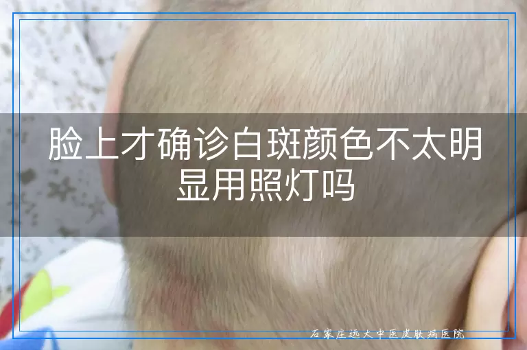 脸上才确诊白斑颜色不太明显用照灯吗