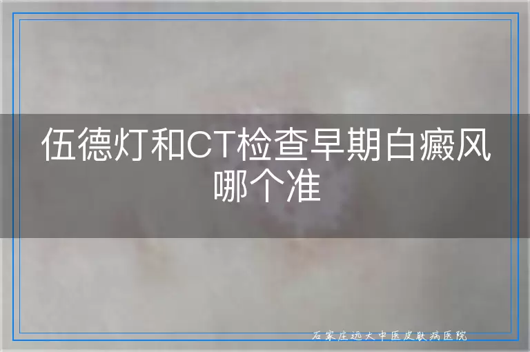 伍德灯和CT检查早期白癜风哪个准