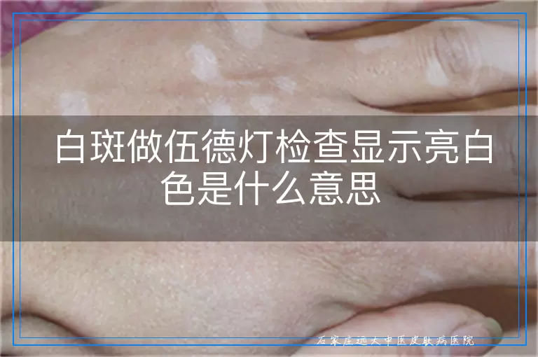 白斑做伍德灯检查显示亮白色是什么意思