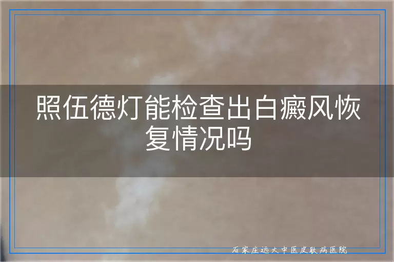 照伍德灯能检查出白癜风恢复情况吗