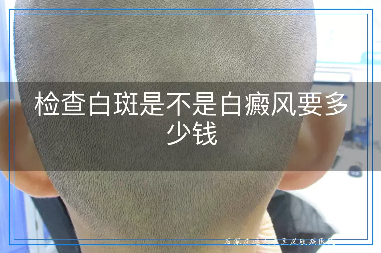 检查白斑是不是白癜风要多少钱