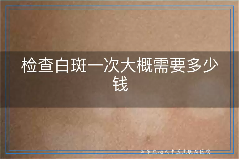检查白斑一次大概需要多少钱