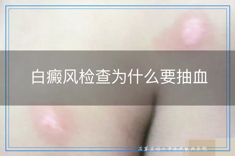 白癜风检查为什么要抽血