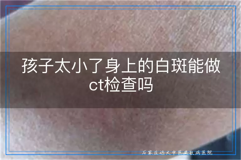 孩子太小了身上的白斑能做ct检查吗