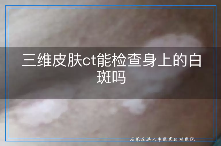 三维皮肤ct能检查身上的白斑吗