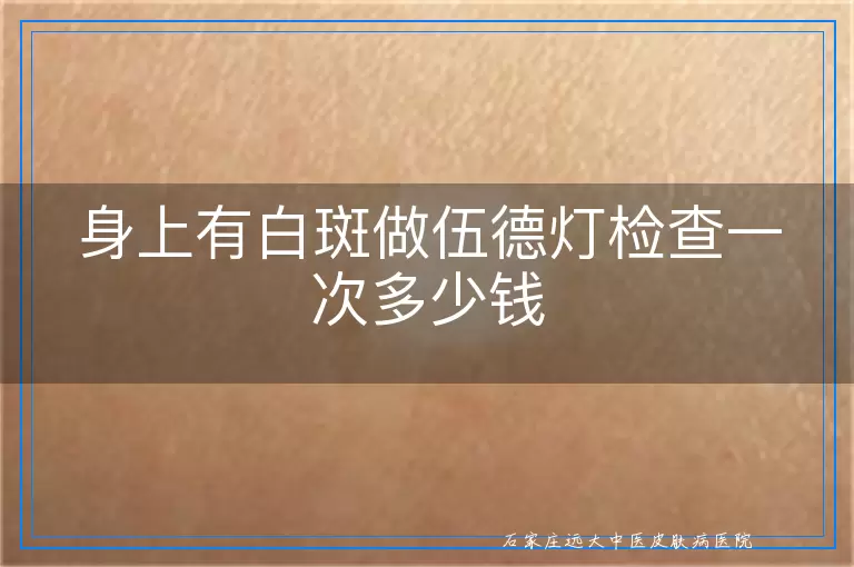 身上有白斑做伍德灯检查一次多少钱